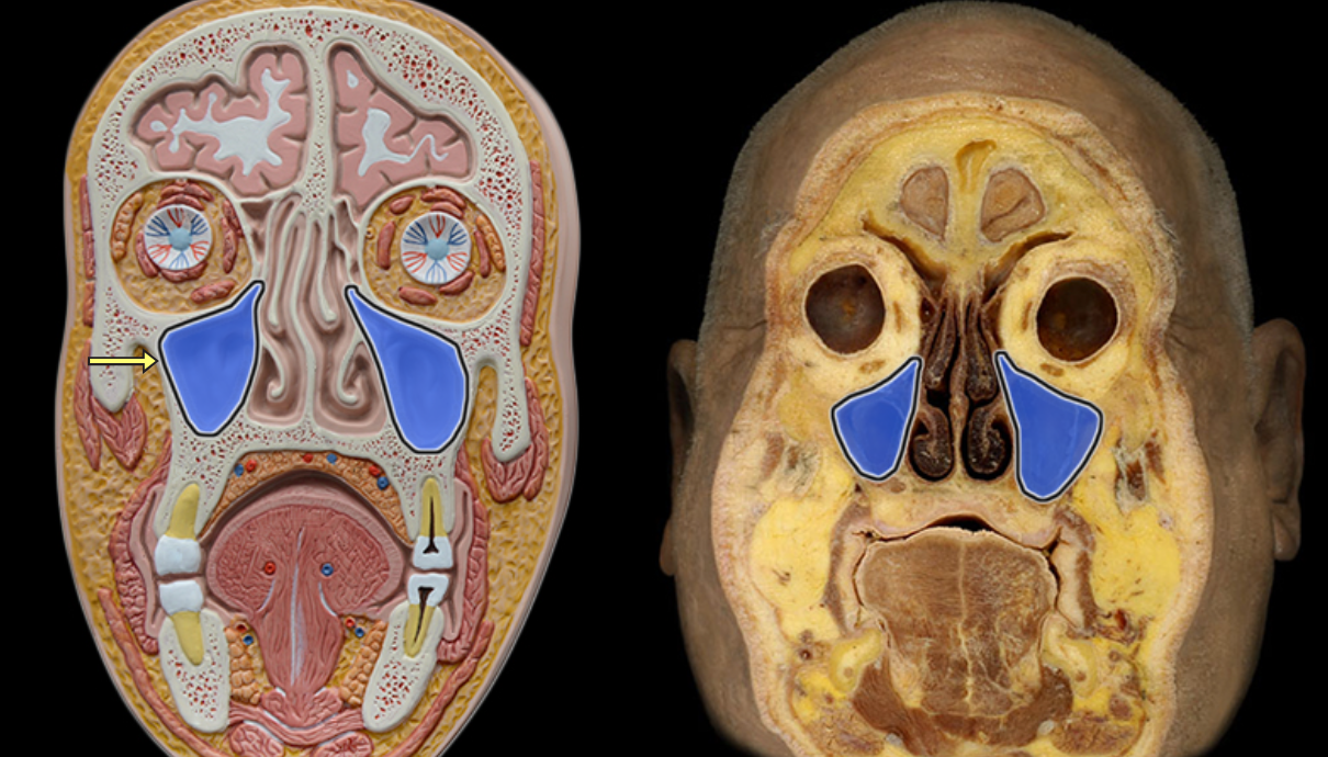 <p>Maxillary sinus</p>