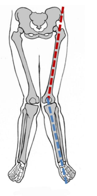 <p>Valgus knee (knock-kneed)</p>