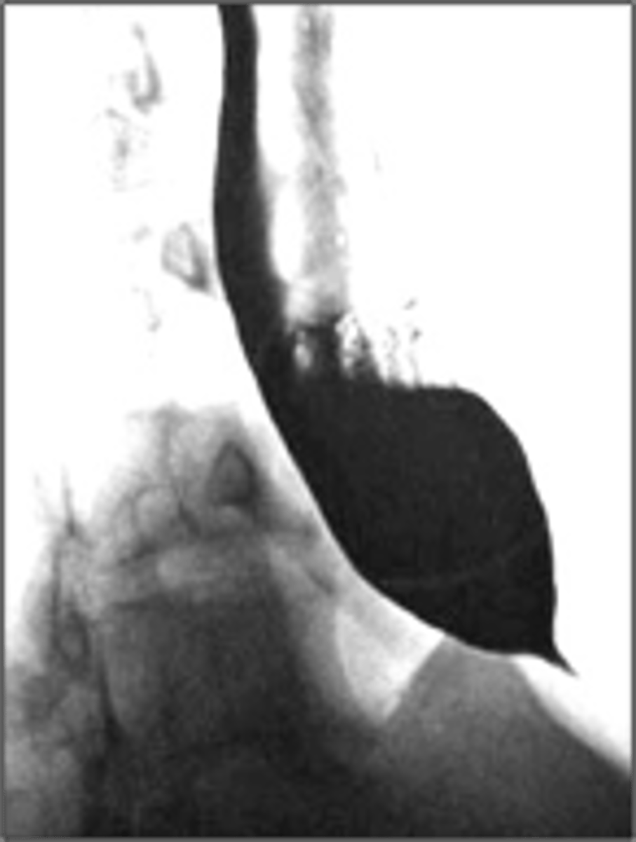 <p>What has the following characteristics?</p><p>• Motility disorder</p><p>• Dysphagia to solids and liquids</p><p>• Absent ganglion cells</p><p>• Distal stricture “birds beak” on barium</p>