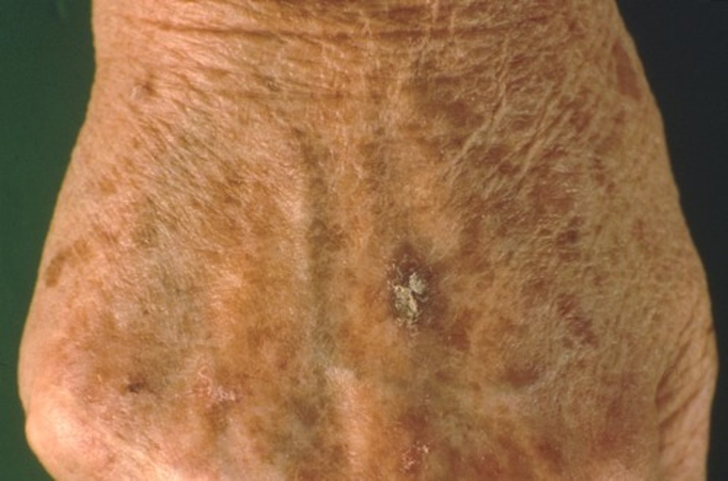 <p>= premaligne huidletsel dat voorkomt op zonblootgestelde delen van de huid.</p>