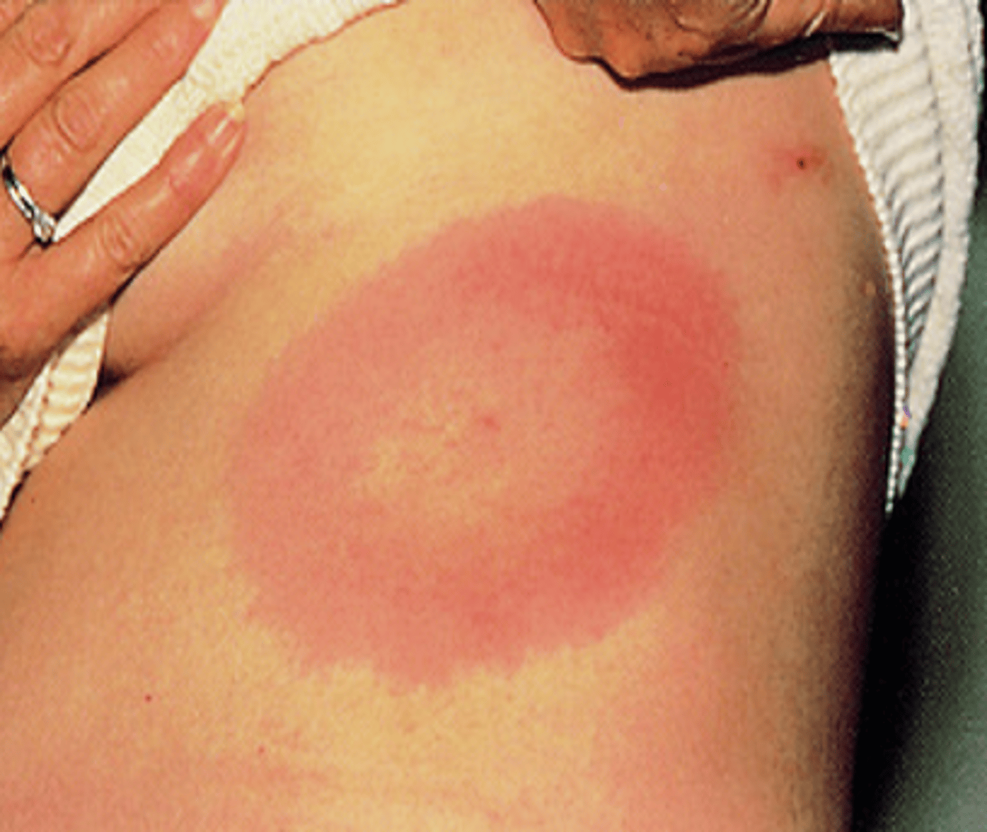 <p>-Tick-borne disease</p><p>-Causes erythema migrans</p>