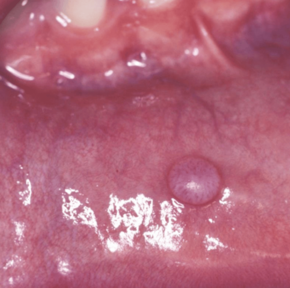 <p>Mucocele</p>