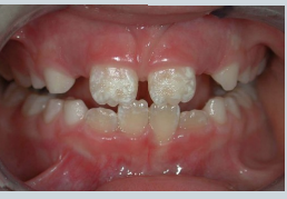 <ol><li><p>Nutritional deficiencies</p><ul><li><p><strong>Vitamin D /</strong> Calcium deficiency</p></li></ul></li><li><p>Pre/Perinatal issues</p><ul><li><p><strong>Maternal </strong>infections e.g. <strong>rubella and syphilis</strong></p></li><li><p><strong>Prematurity </strong>/ Low birth weight</p></li></ul></li><li><p>Infectious diseases</p><ul><li><p>Febrile illnesses in early childhood</p></li><li><p>Measles, chickenpox, scarlet fever</p></li></ul></li><li><p>Endocrine</p><ul><li><p>Hypoparathyroidism (abnormal calcium/phosphate</p></li><li><p>regulation)</p></li><li><p>Hypothyroidism – delayed tooth eruption</p></li><li><p>Chronic Renal Disease – disrupting calcium/phosphate</p></li></ul></li><li><p>Coeliac Disease – nutrient malabsorption </p></li><li><p>genetics </p><ul><li><p>amelogenesis imperfecta </p></li><li><p>down syndrome </p></li></ul></li></ol><p></p>