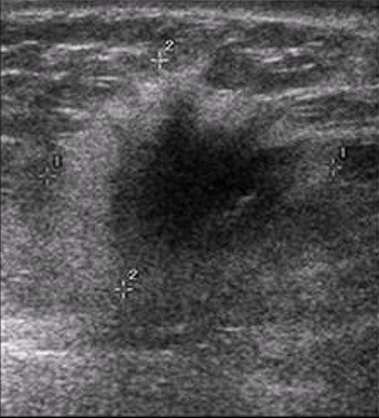 <ul><li><p>rare and aggressive form of breast cancer</p></li><li><p>symptoms: reddening and swelling, may or may not have distinct lump, skin looks like an <u>orange peel</u></p></li><li><p>sonographic appearance: thick, echogenic skin, dilated lymph vessels and veins, and hypervascular</p></li></ul><p></p>