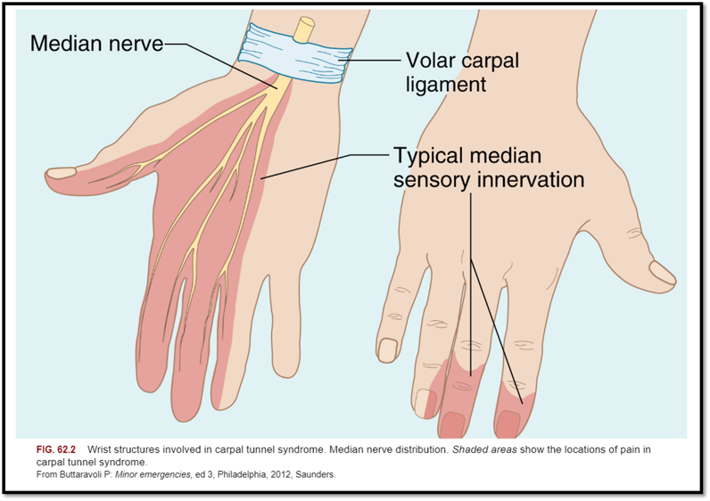 <p><span>•Caused by compression of the median nerve, or pressure from trauma or edema caused by inflammation of a tendon, neoplasm, RA, or soft tissue mass.</span></p><p><span>•</span><strong><span>Signs/Symptoms</span></strong><span>: weakness, burning pain, numbness, impaired sensation, clumsiness, may awaken patient at night with numbness and tingling.</span></p><p><span>•</span><strong><span>Diagnostics</span></strong><span>: Tinel’s and Phalen’s Test</span></p><p><span>•</span><strong><span>Treatment:</span></strong><span> Corticosteriod injections, surgery</span></p><p><span>•</span><strong><span>Nursing Care</span></strong><span>: wrist splints and physical therapy</span></p>