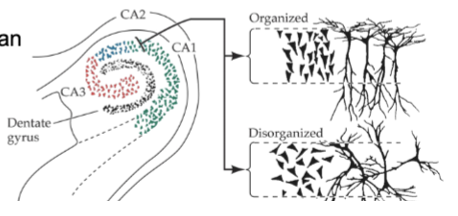 <p>enlarged ventricles (transport cerebrospinal fluid) due to smaller hippocampus/temporal lobe regions with schizophrenia</p><ul><li><p>altered organization of hippocampal neurons - during development can disrupt how brain processes info</p></li><li><p>not lesioned, just a size thing</p></li></ul><p></p>