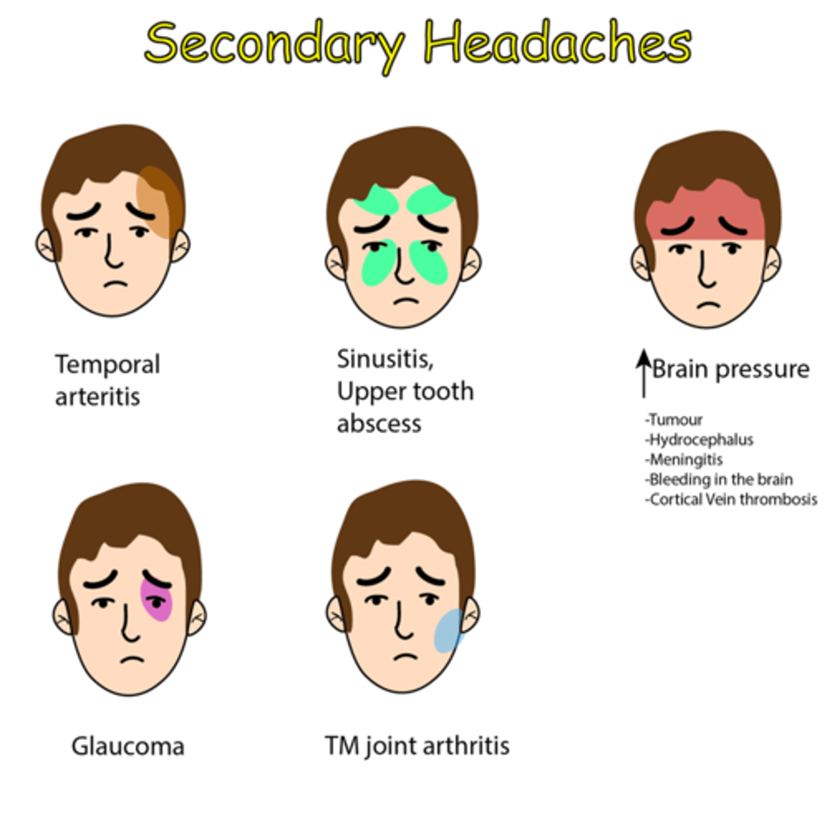 <p>Felt as a result or symptom of a different pathology (e.g., whiplash, environmental changes,TBI)</p>