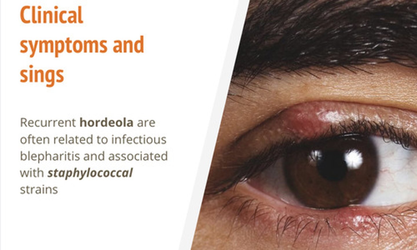 <p>stye; acute infection of sebaceous glands of Zeis</p>