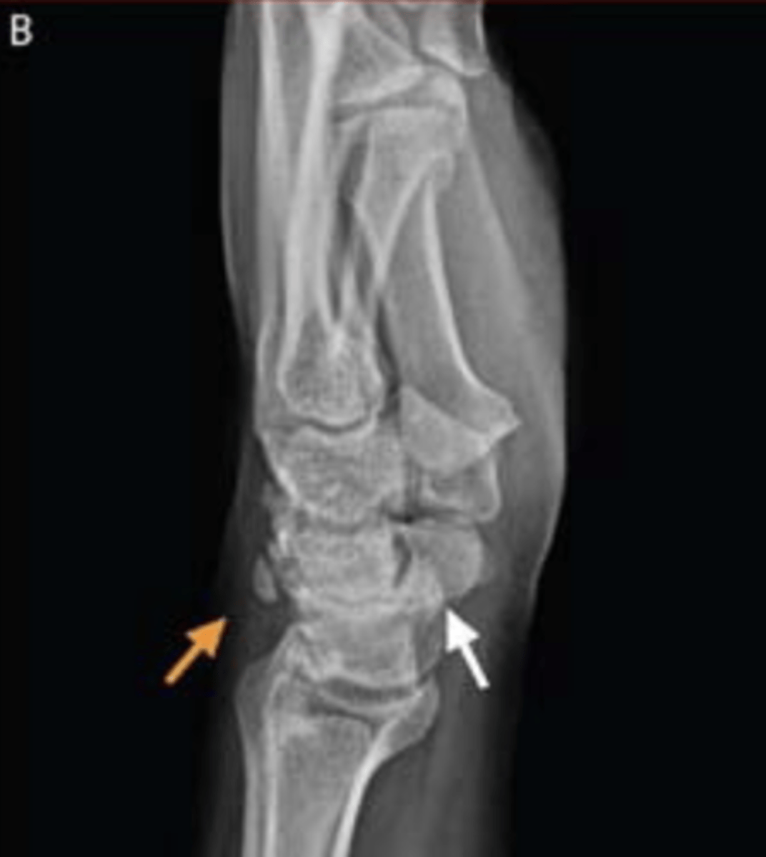 <p>remote triquetral fracture</p><p>3 multiple choice options</p>