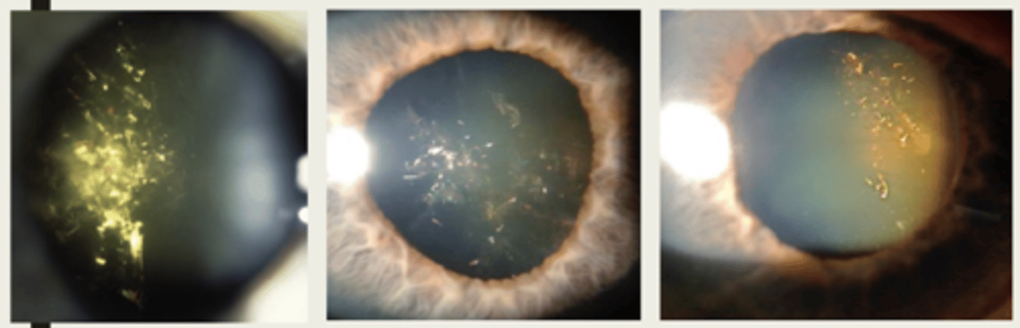 <p>polychromic (many colors) crystals in cortex - crystals will morph into stellate cataract</p>