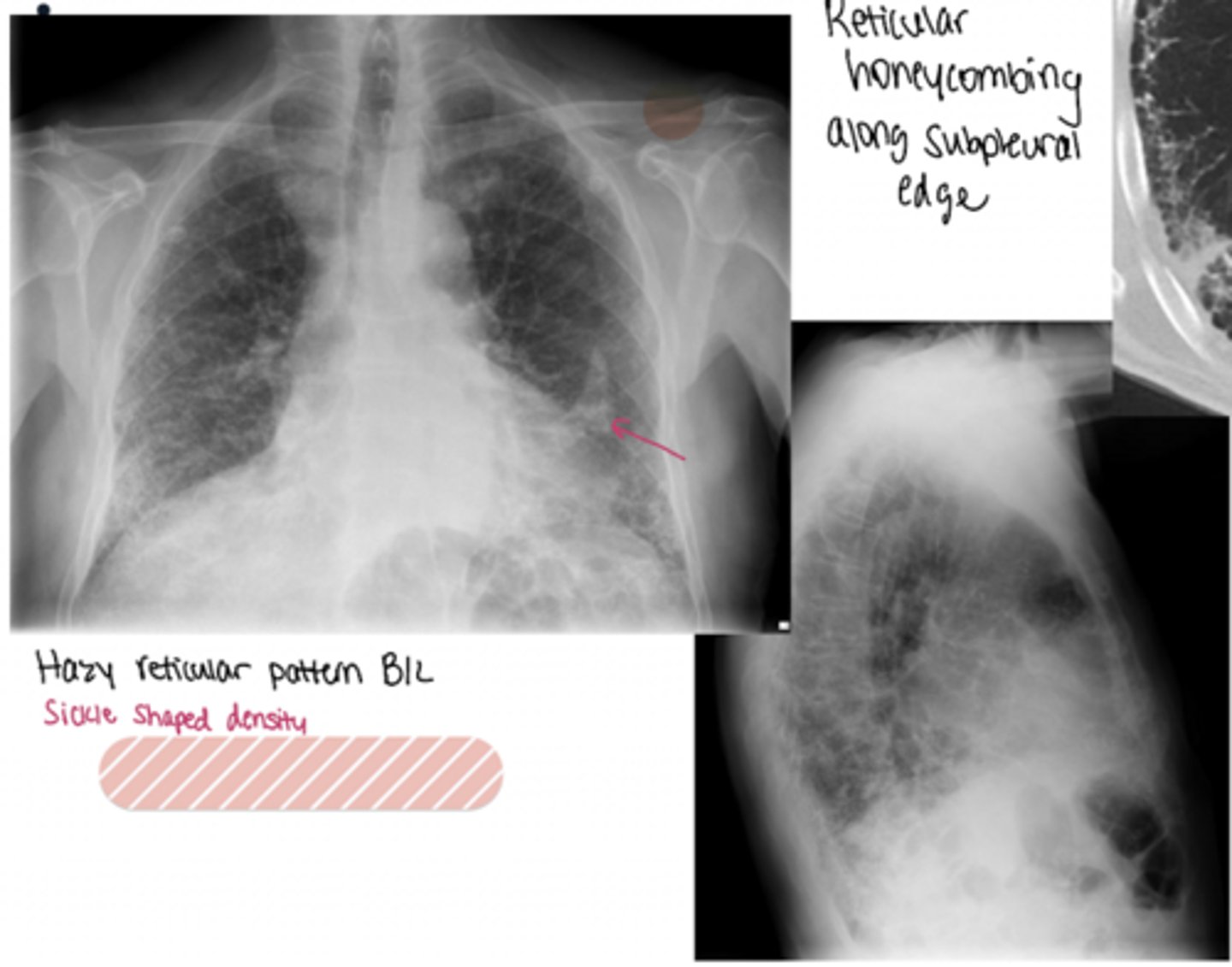 <p>This patient worked in the ship/automotive industry his whole life</p>