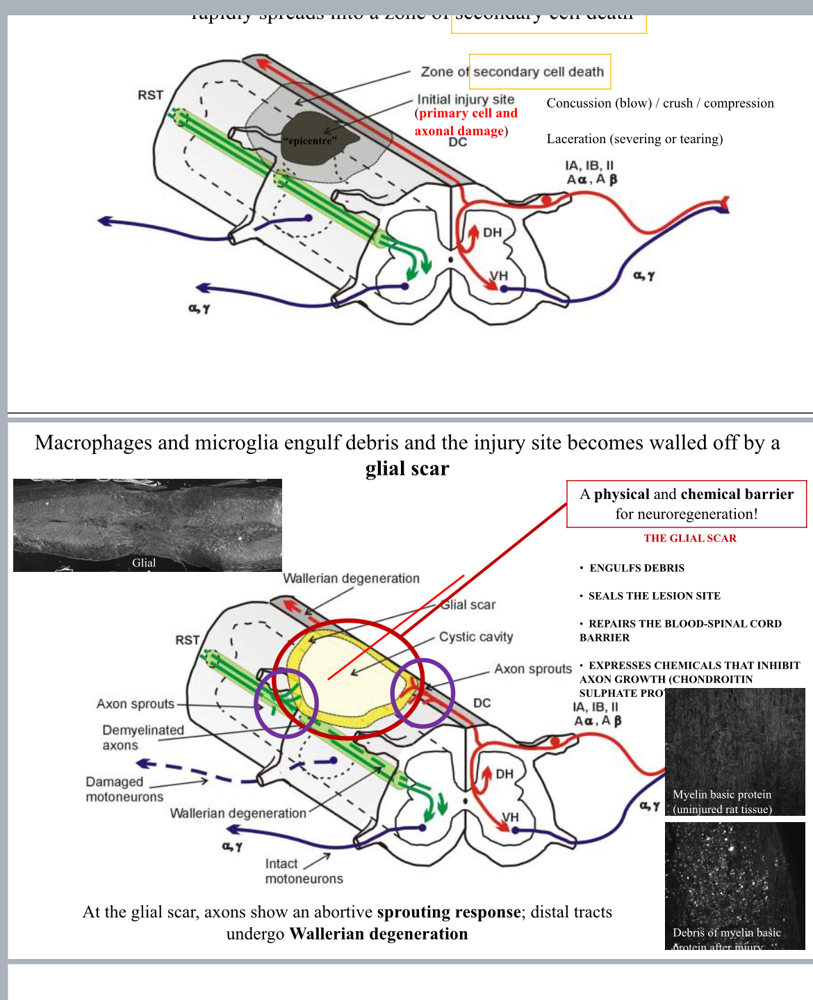<p>To the zone of secondary cell death. </p>