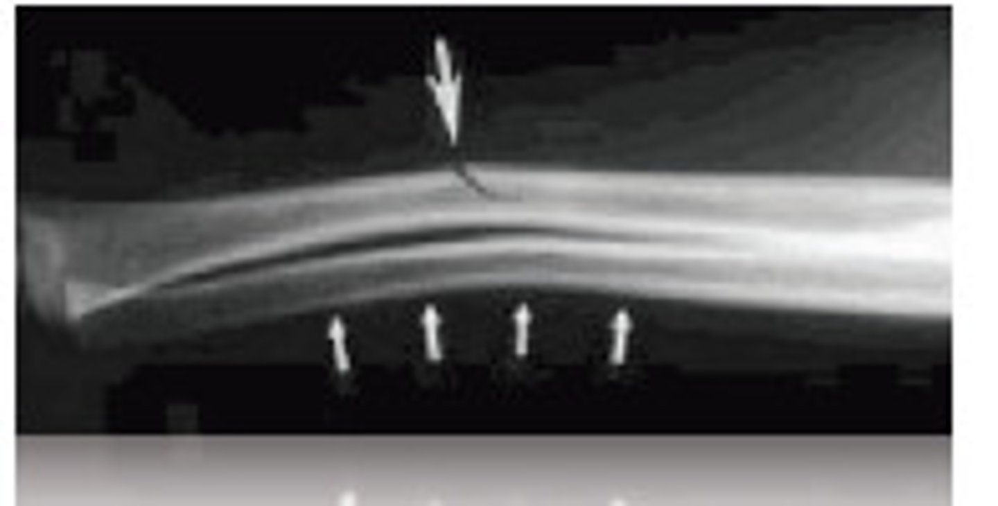 <p>Bone not broken completely through</p>
