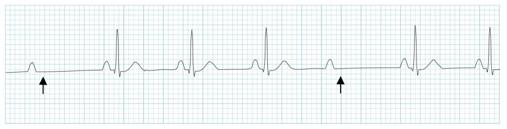<p>PR interval is constant + dropped beat</p>