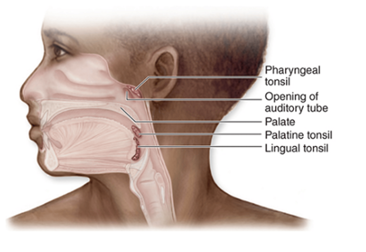 <p>What is nodular MALT in the tonsils?</p>