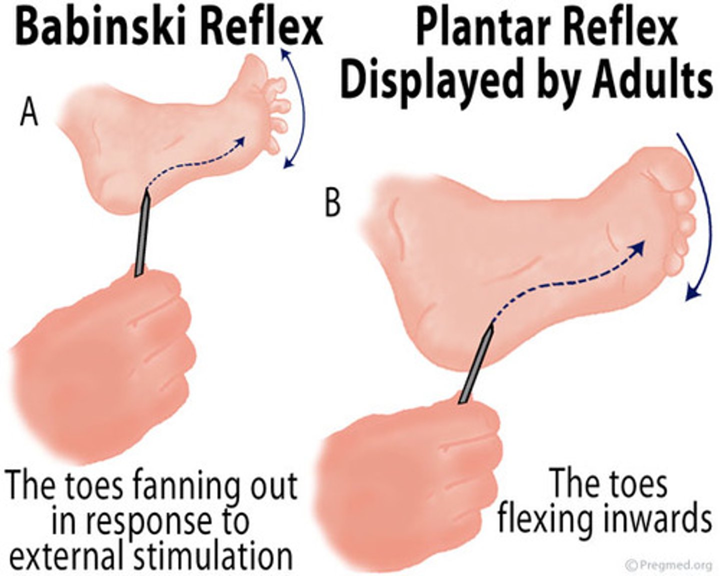 <p>Reflex in which a newborn fans out the toes when the sole of the foot is touched; adults will plantarflex</p>