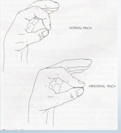 <p>Neuro: pinch Grip test</p>