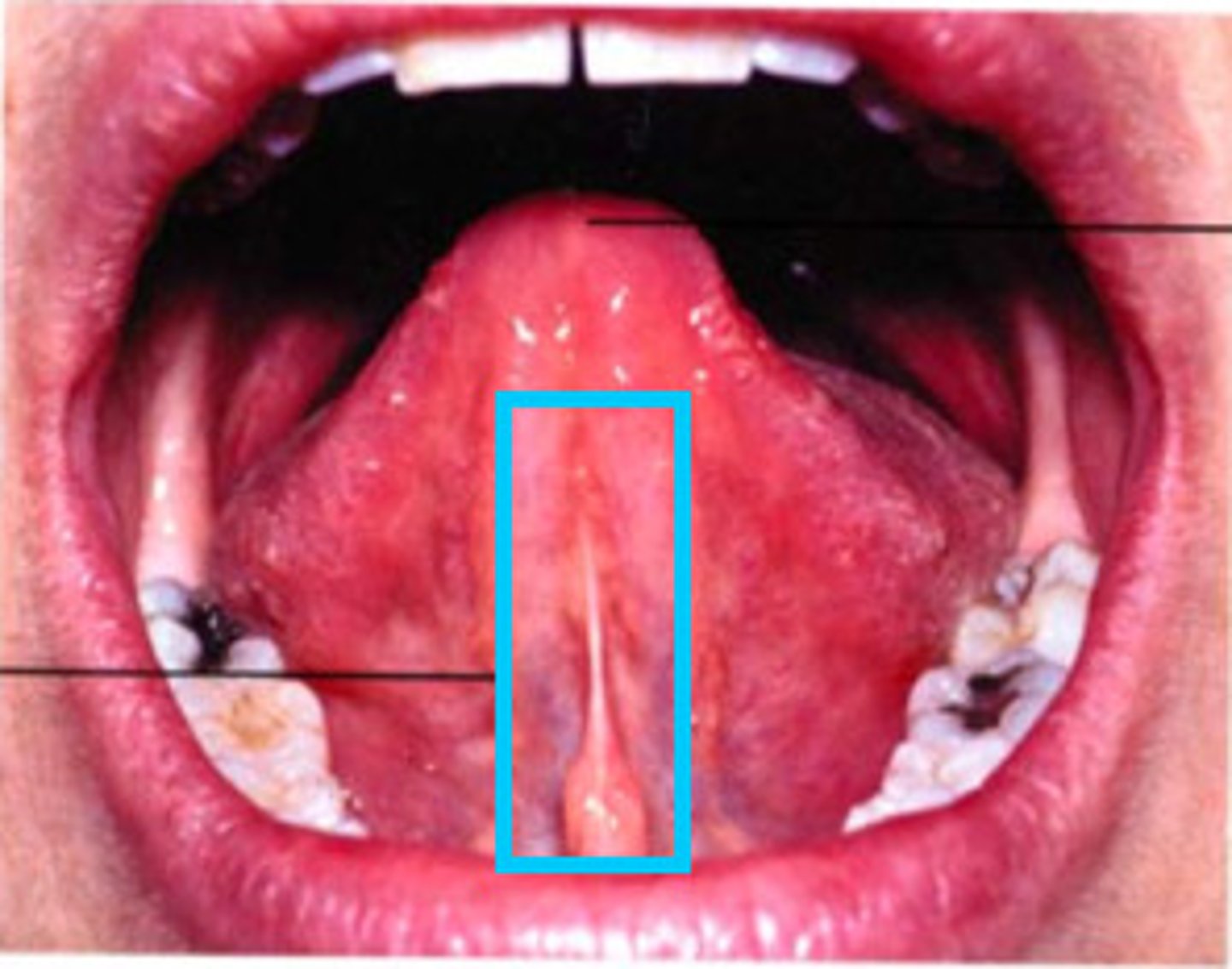 <p>midline fold of tissue between the ventral surface of the tongue and the floor of the mouth</p>
