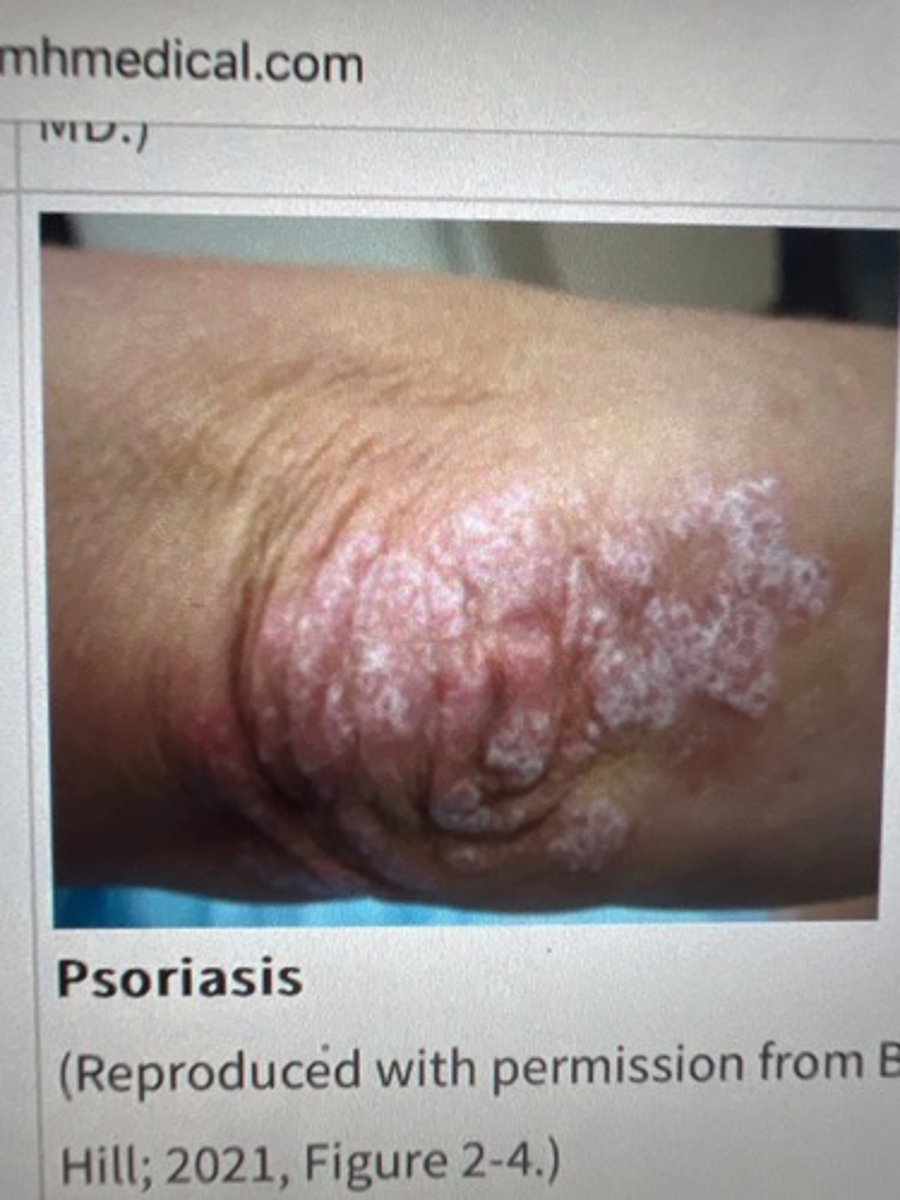 <p>heaped-up keratinized cells, flaky skin, irregular, thick or thin, dry or oily, variation in size</p>