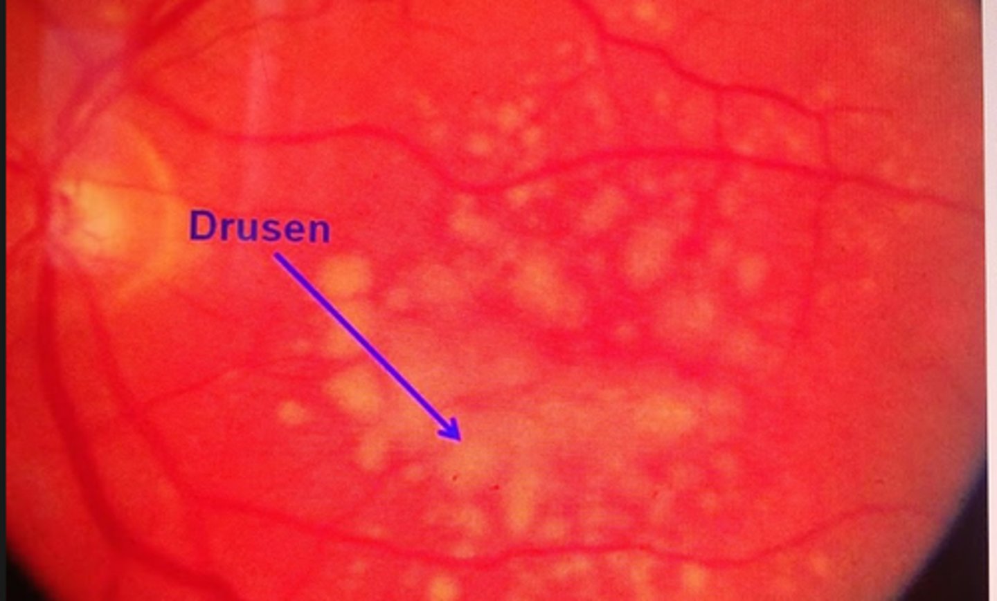 <p>Macular degeneration</p>