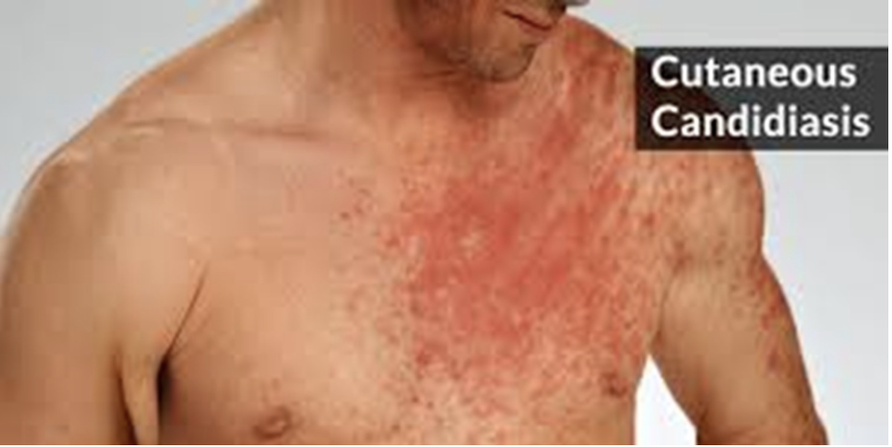 <p>what is the microbe that mainly causes cutaneous candidiasis?</p>