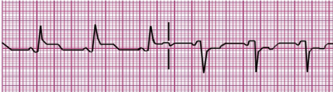 <ul><li><p class="Paragraph SCXW82654627 BCX0" style="text-align: left;"><span style="line-height: 24.4125px;">Some variation in EKG&nbsp;</span></p></li></ul><ul><li><p class="Paragraph SCXW82654627 BCX0" style="text-align: left;"><span style="line-height: 24.4125px;">Typically, in trauma&nbsp;</span></p></li></ul><ul><li><p class="Paragraph SCXW82654627 BCX0" style="text-align: left;"><span style="line-height: 24.4125px;">Massive volume loss d/t trauma -&gt; no volume in atria -&gt; heart is pumping (creates rhythm) -&gt; no blood ejecting -&gt; no pulse = PEA&nbsp;</span></p></li><li><p class="Paragraph SCXW82654627 BCX0" style="text-align: left;"><span style="background-color: rgba(0, 0, 0, 0); line-height: 24.4125px;"><strong>CPR then Epi</strong></span></p></li></ul><p></p>