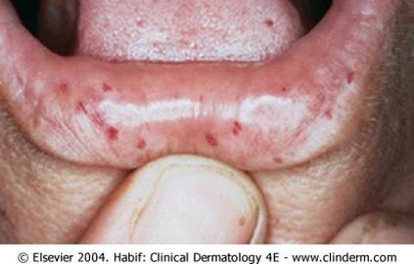 <p>small red spots on lips</p><p>Iron deficiency anemia</p><p>Nose bleeds</p><p>GI bleeding</p>