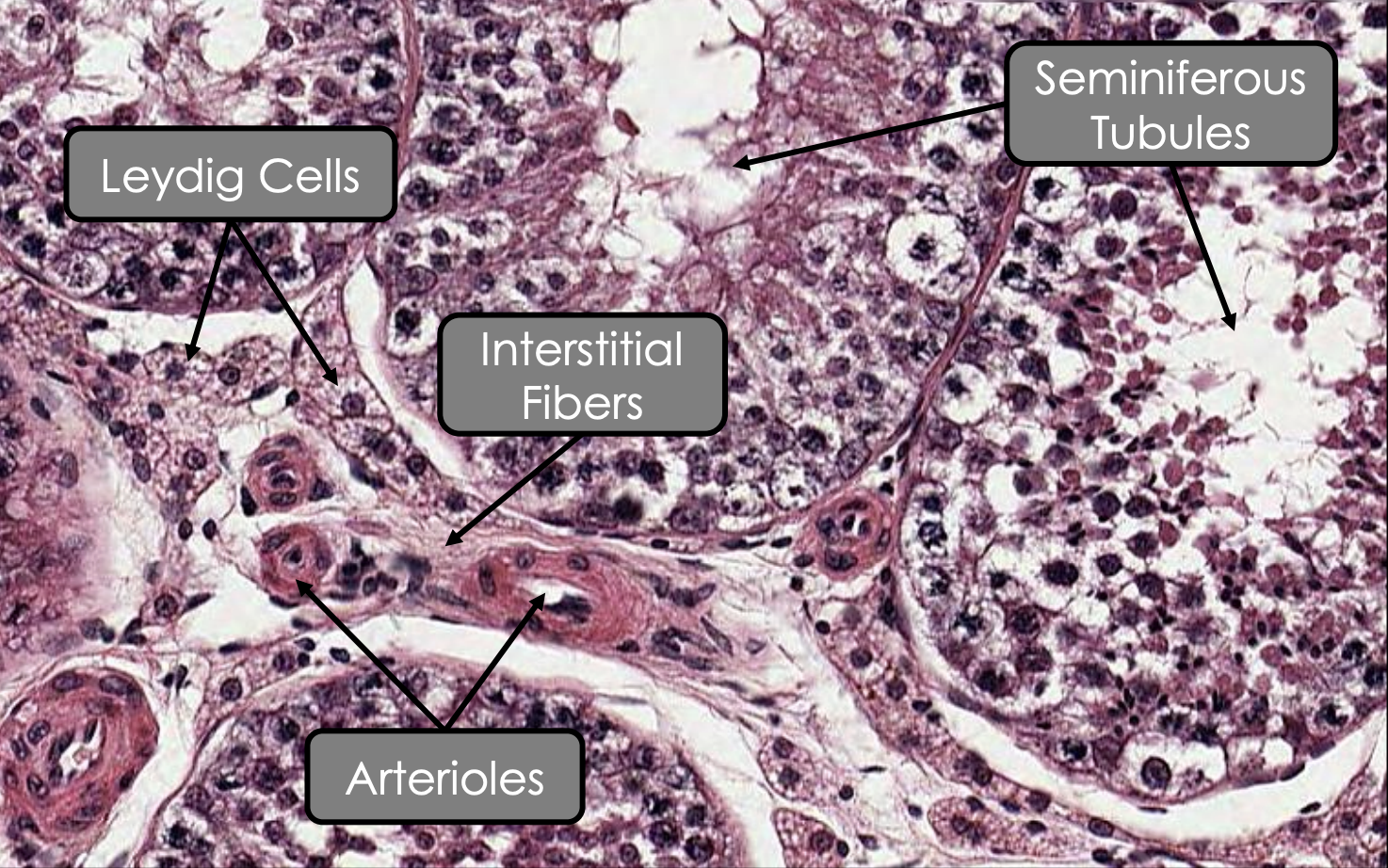 <p><span style="color: rgb(0, 165, 255);"><strong><u><mark data-color="blue" style="background-color: blue; color: inherit;">Interstitial fibers</mark></u></strong></span></p><ul><li><p><strong><u>What:</u>&nbsp;</strong><span style="color: rgb(0, 165, 255);"><strong>Infiltration</strong></span><strong> </strong>of <span style="color: rgb(0, 165, 255);"><strong>loose connective tissue </strong></span></p></li><li><p><strong><u>From:</u> </strong><span style="color: rgb(0, 165, 255);"><strong>Septula testis</strong></span></p></li><li><p><strong><u>Surrounds:</u> </strong><span style="color: rgb(0, 165, 255);"><strong>Seminiferous tubules</strong></span></p></li></ul><p><span style="color: rgb(0, 165, 255);"><strong><u><mark data-color="blue" style="background-color: blue; color: inherit;">Interstitial cell</mark></u></strong></span></p><ul><li><p><strong><u>Name:</u> </strong><span style="color: rgb(0, 165, 255);"><strong>Leydig cells</strong></span></p></li><li><p><strong><u>Arrangement:</u> </strong><span style="color: rgb(0, 165, 255);"><strong>Clusters</strong></span><strong> </strong>or <span style="color: rgb(0, 165, 255);"><strong>cords</strong></span></p></li><li><p><strong><u>Adjacent to:</u> </strong><span style="color: rgb(0, 165, 255);"><strong>Capillaries</strong></span></p><ul><li><p><strong><u>How they connect:</u> </strong><span style="color: rgb(0, 165, 255);"><strong>Gap junctions</strong></span></p></li></ul></li><li><p><strong><u>Cytoplasm:</u></strong></p><ul><li><p><span style="color: rgb(0, 165, 255);"><strong>Pale</strong></span> due to<strong> </strong><span style="color: rgb(0, 165, 255);"><strong>acidophilical cytoplasm</strong></span></p></li></ul></li><li><p><strong><u>Shape:</u></strong>&nbsp;<span style="color: rgb(0, 165, 255);"><strong>Polyhedral</strong></span><strong>&nbsp;</strong></p></li><li><p><strong><u>Nucleus:</u>&nbsp;</strong></p><ul><li><p><span style="color: rgb(0, 165, 255);"><strong>Spherical&nbsp;</strong></span></p></li><li><p><span style="color: rgb(0, 165, 255);"><strong>Euchromatic </strong></span></p></li></ul></li><li><p><strong><u>Abundant of which organelles:</u></strong></p><ul><li><p><span style="color: rgb(0, 165, 255);"><strong>Lopid vacuoles </strong></span></p></li><li><p><span style="color: rgb(0, 165, 255);"><strong>sER </strong></span></p></li><li><p><span style="color: rgb(0, 165, 255);"><strong>Mitochondria</strong></span></p></li></ul></li><li><p><strong><u>Function:</u> </strong><span style="color: rgb(0, 165, 255);"><strong>Synthesise testosterone</strong></span><strong> </strong>under influenced of<span style="color: rgb(0, 165, 255);"> <strong>LH</strong></span></p></li></ul><p></p>
