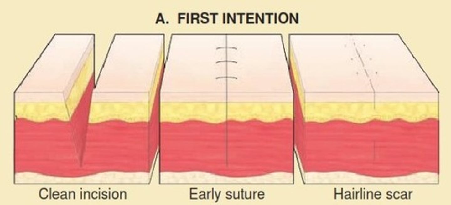 <p>This is the simplest and fastest type of closure, occurring when wound edges are physically approximated using sutures, staples, adhesive tapes, or biologic glues</p>
