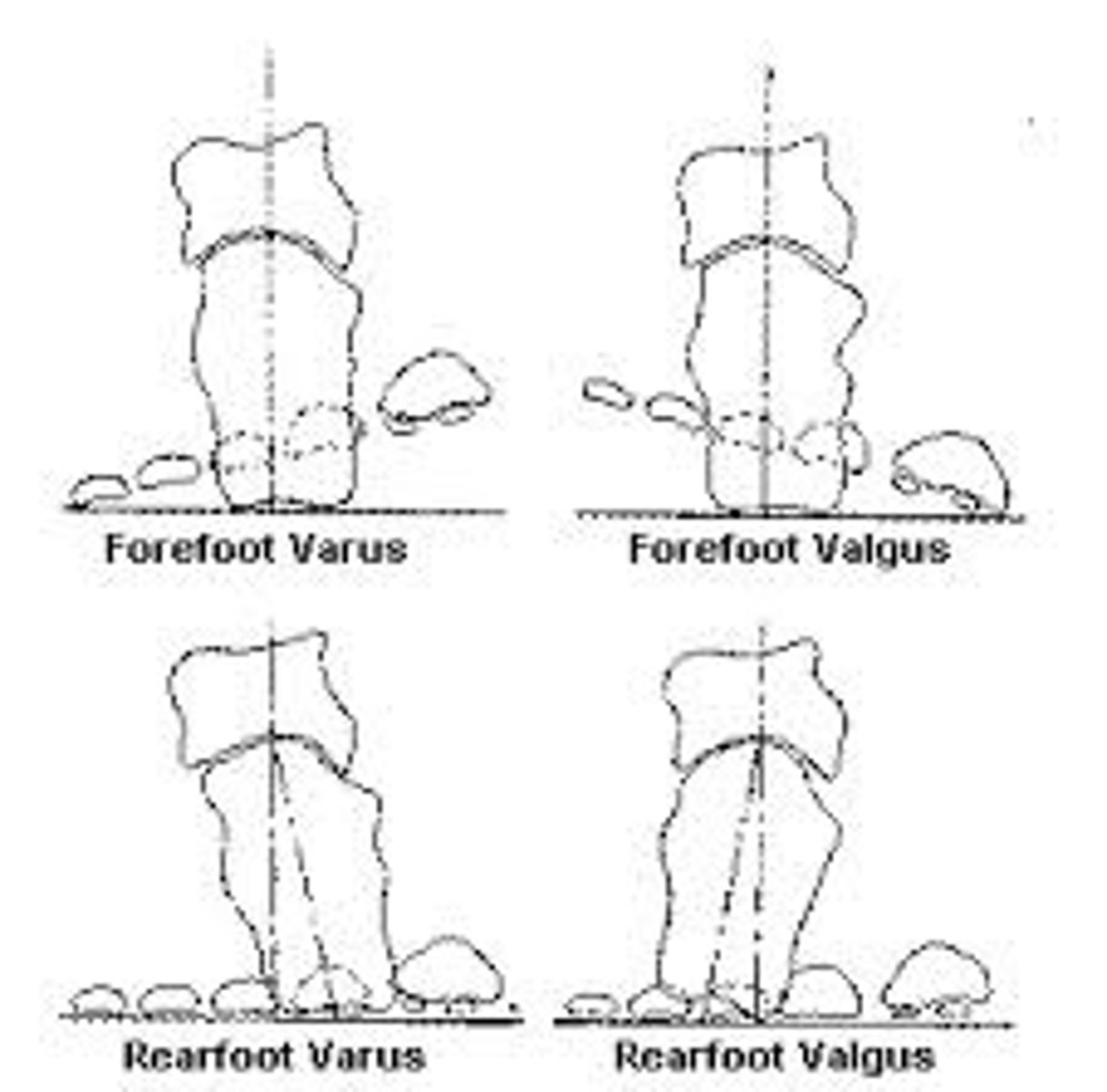<p>neutral</p><p>if compensated it would go in the opposite direction of the forefoot</p>
