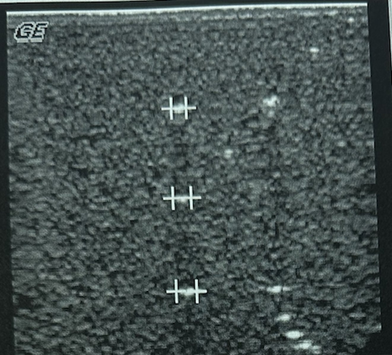 <p>What is being measured on the three rods in the center of this image?</p><p>A. Axial resolution</p><p>B. Penetration</p><p>C. Elevational resolution</p><p>D. Lateral resolution</p><p>E. Temporal resolution</p>