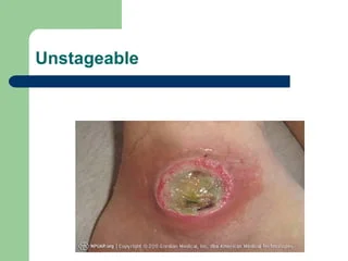 <p>Unstageable “Slough” </p>