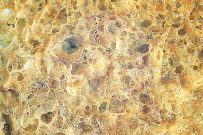 <p>Tipo de enfisema </p>