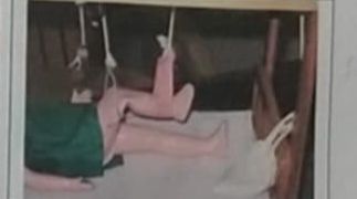 <p>Suprachanteric and proximal 3rd fracture of the femur</p>