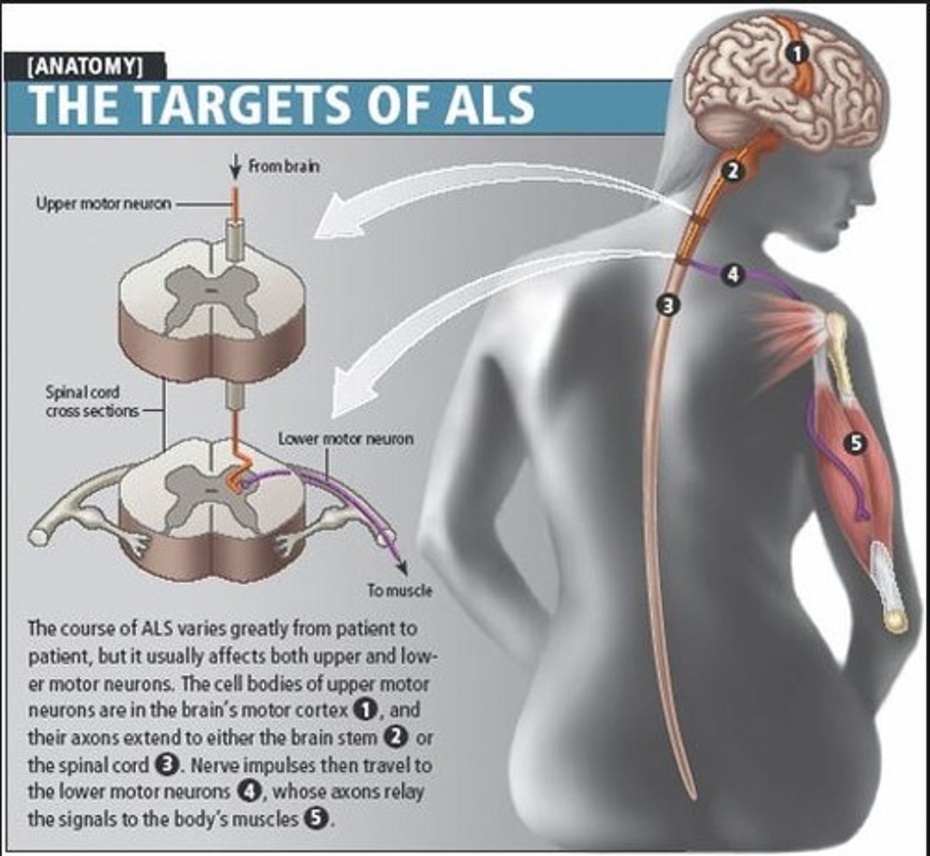 <p>Also known as Lou Gehrig's Disease; a progressive neurological disease that causes motor neurons not to function properly; over time, this leads to muscle weakness, gradually affecting how the body functions; the condition eventually affects nerves that control breathing and other vital bodily functions, resulting in death; there is no cure, medicines (i.e. Riluzole) control symptoms; symptoms are treated with physical therapy</p>