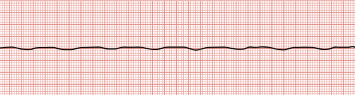 <p>Complete absence of any waves on the EKG tracing.</p>