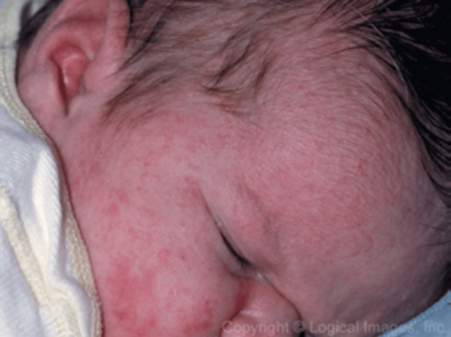 <p>A COMMON and non-threatening PINK RASH in newborns that is typically present in the first 3 weeks of life then disappears.</p>