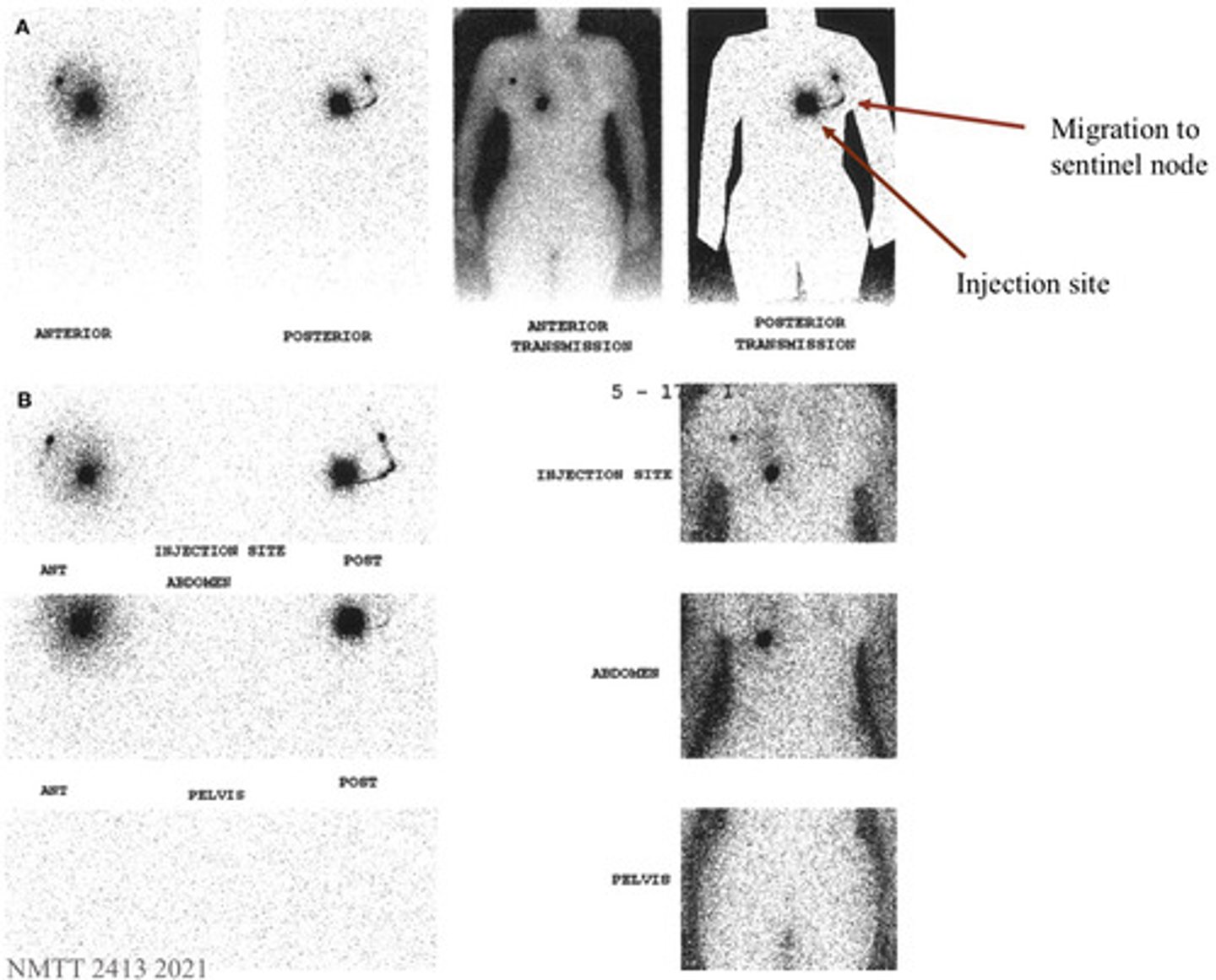 <p>Measured during rest and exercise - identifies lymphatic insufficiency</p>