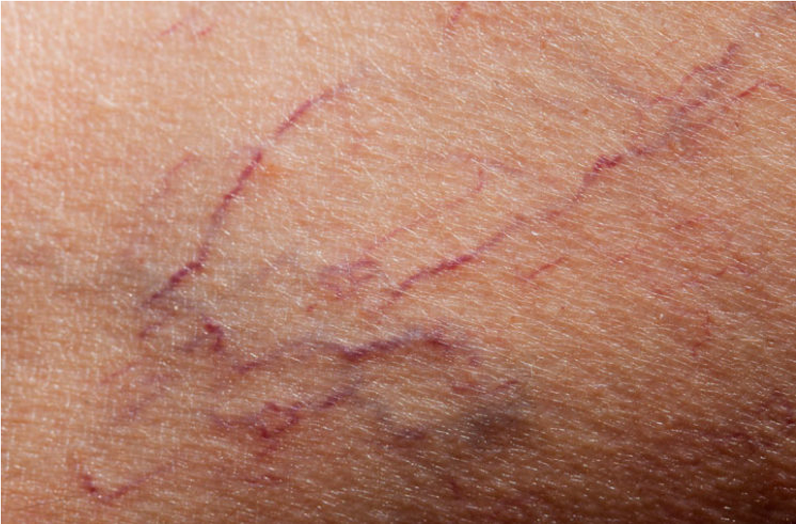 * dilated venules close to the skin, especially in the lower limb and face
* appear red, blue or purple, resembling a spider web
* accompanied by pain and discomfort in the affected area