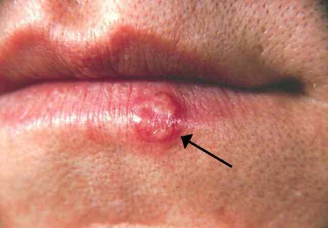 <p>Cold sore or fever blister on the lip or nose due to the herpes virus</p>