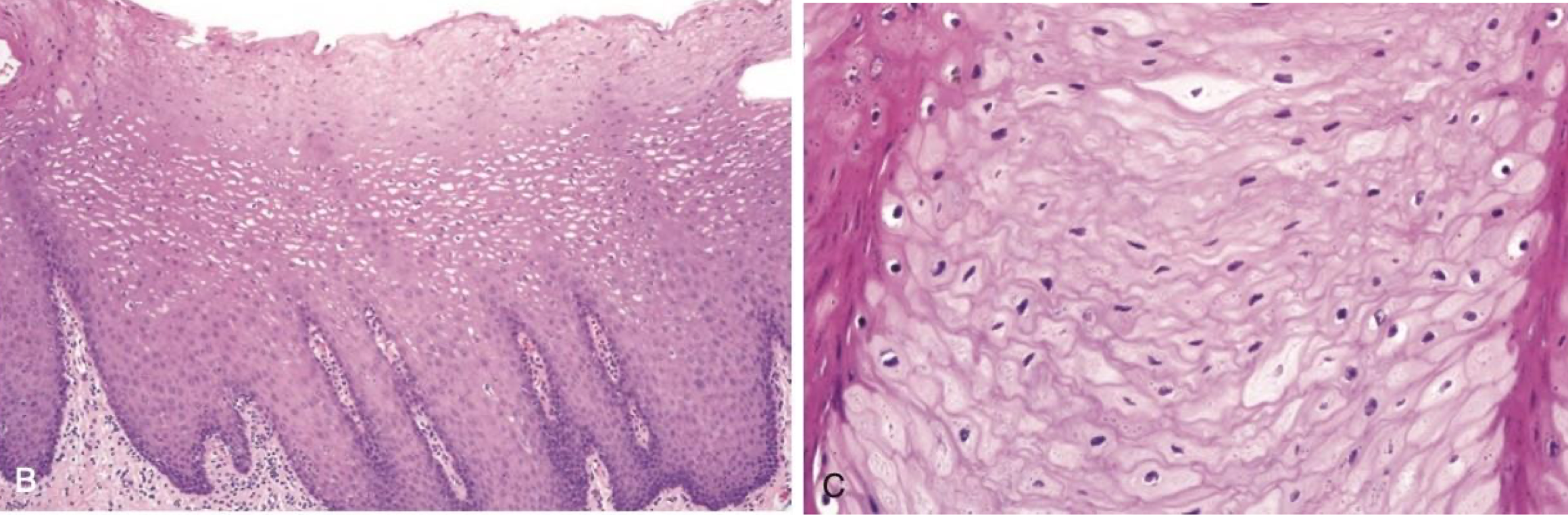<p>which environmental/reactive lesion: acanthotic edematous change</p>