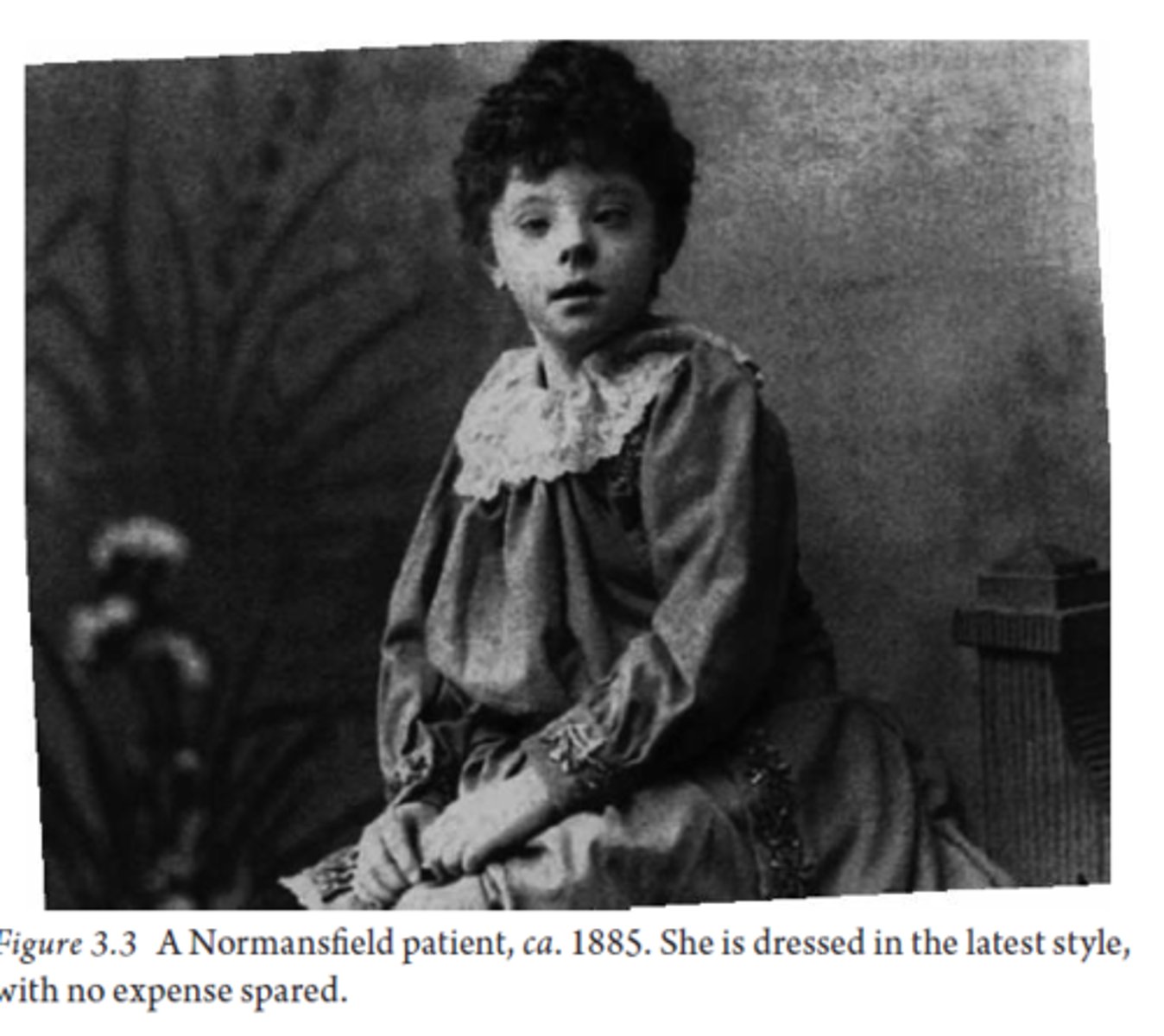 <p>A portrait of Clementine F. 'Tillie' Eadie, indicating genetic or developmental disability, challenging beliefs about the visibility of disabled children in the 19th century.</p>