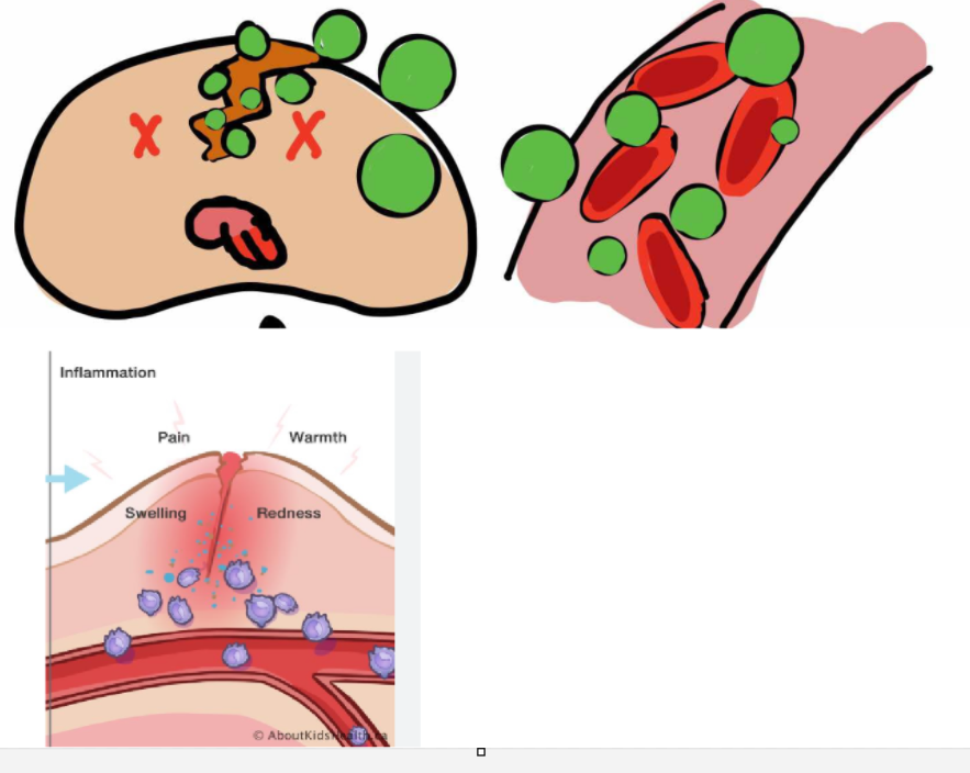 <p>waste products from destroyed cells are released into the blood stream AND an <strong>inflammatory rxn </strong>begins</p>