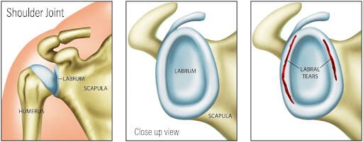 <p>Shoulder Labrum</p>