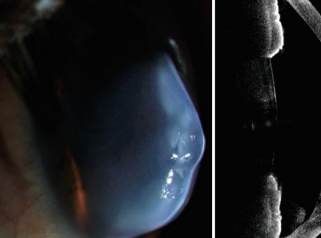 <ul><li><p>rupture in descemets memrbane</p></li><li><p>aqueous humor flows through damaged endothelium &gt; leading to corneal edema + eventual scarring</p></li></ul>