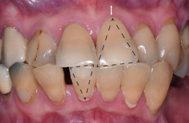 <p>Slender, triangular-shaped crown</p><p>Thin, delicate, friable soft tissue with thin alveolar bone</p><p>Narrow zone of keratinized tissue</p><p>Accentuated scalloped gingival margin contour</p><p>Greater tendency for onset, progression of mucogingival deformity</p>