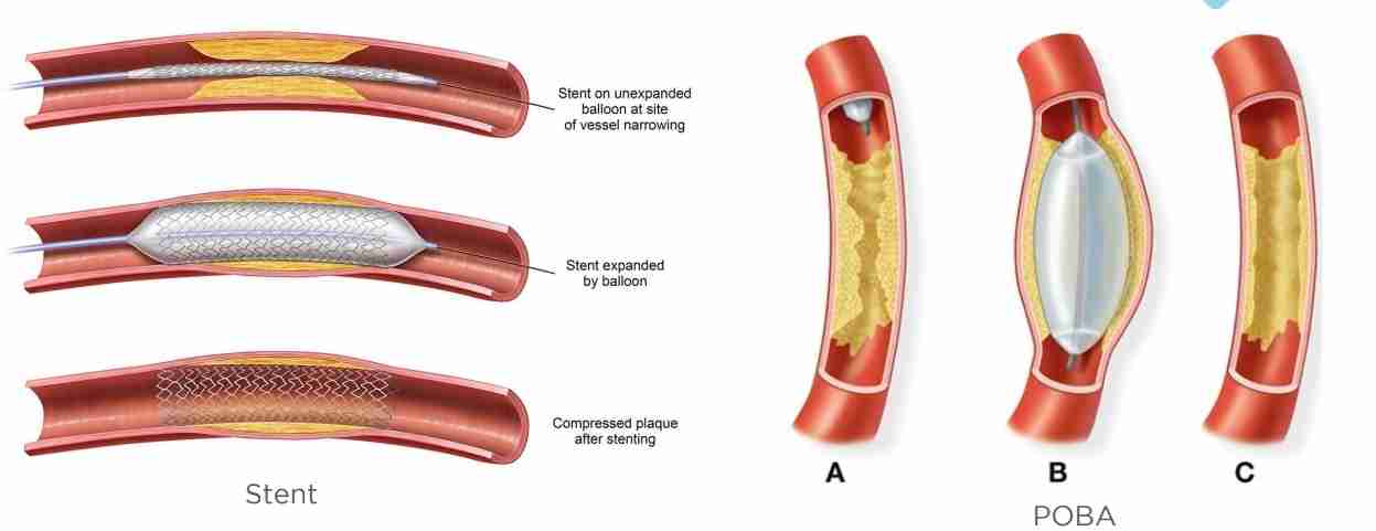 <p>Percutaneous Coronary Intervention</p>