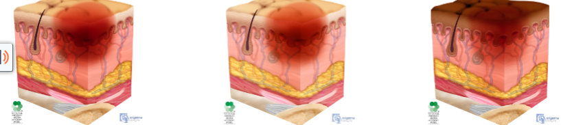 <ul><li><p>intact skin w/ localized are of non-blanchable erythema</p></li></ul><p></p>