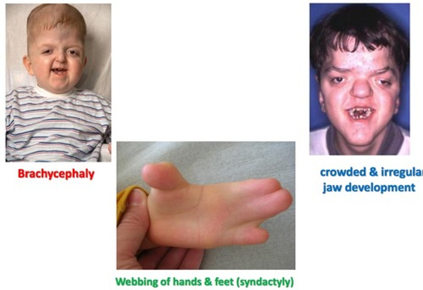 <p>Flat, elongated forehead</p><p>Proptosis</p><p>Underdeveloped midface</p><p>Fusion of the digits (2-3 fingers per hand)</p>