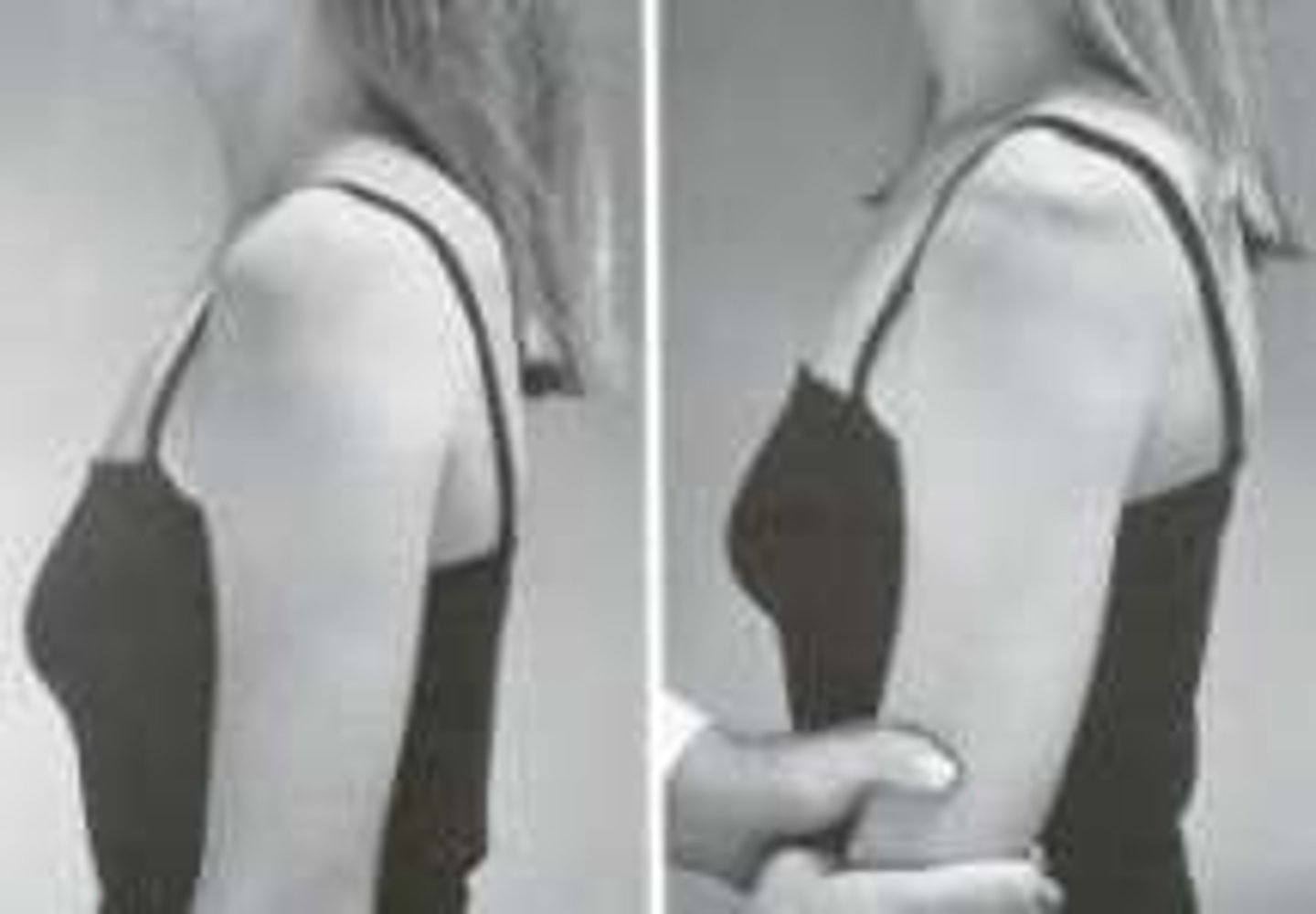<p>- diagnosis: inferior shoulder instability (usually young pts with multidirectional instability)</p><p>- how: ask patient to relax arm down at side (close to body), &amp; pull down an arm</p><p>+ = visible sulcus (gap between acromion &amp; humeral head)</p>